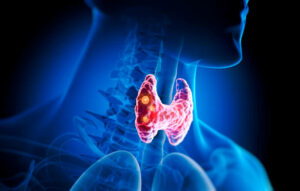 Laglande thyroide responsable de la production d'hormones T3 et T4. Difficile à perdre du poids. Hypothyroidie.